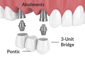 Denture Alternatives