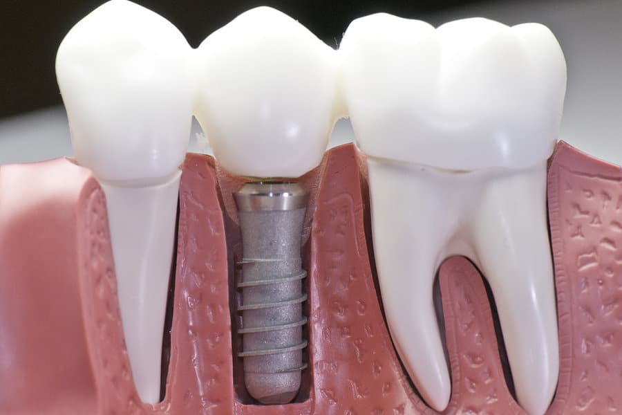 Dental Implants: FAQs About Overdentures - Featured Image