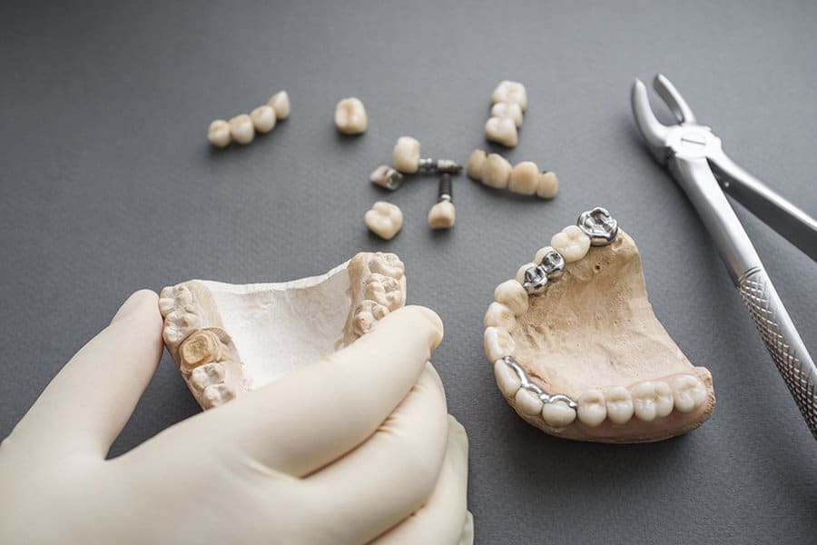 Dental Implants: Types of Dentures - Partial and Complete Dentures - Featured Image