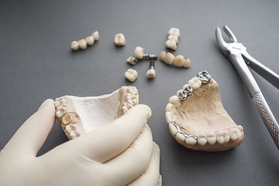 Dental Implants: Types of Dentures - Partial and Complete Dentures - Featured Image