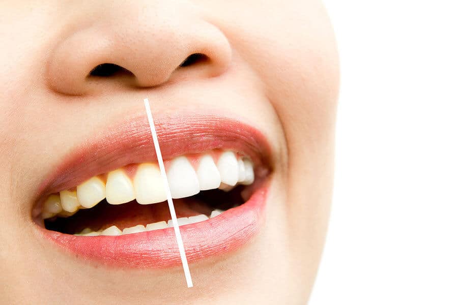Can Teeth Whitening Damage Your Teeth? - Featured Image