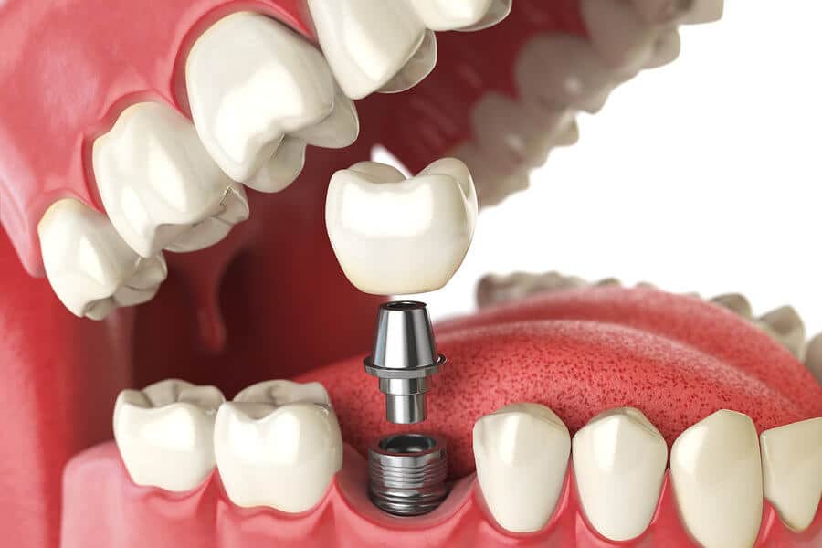 Dental Implants: Everything You Need To Know About Mini Implants - Featured Image