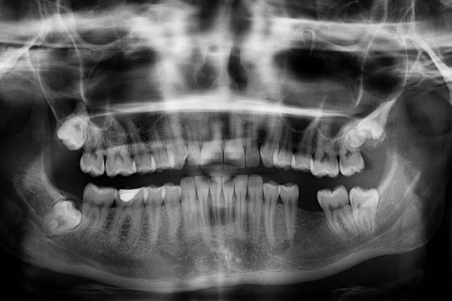 What If I Have A Broken Jaw? - Featured Image