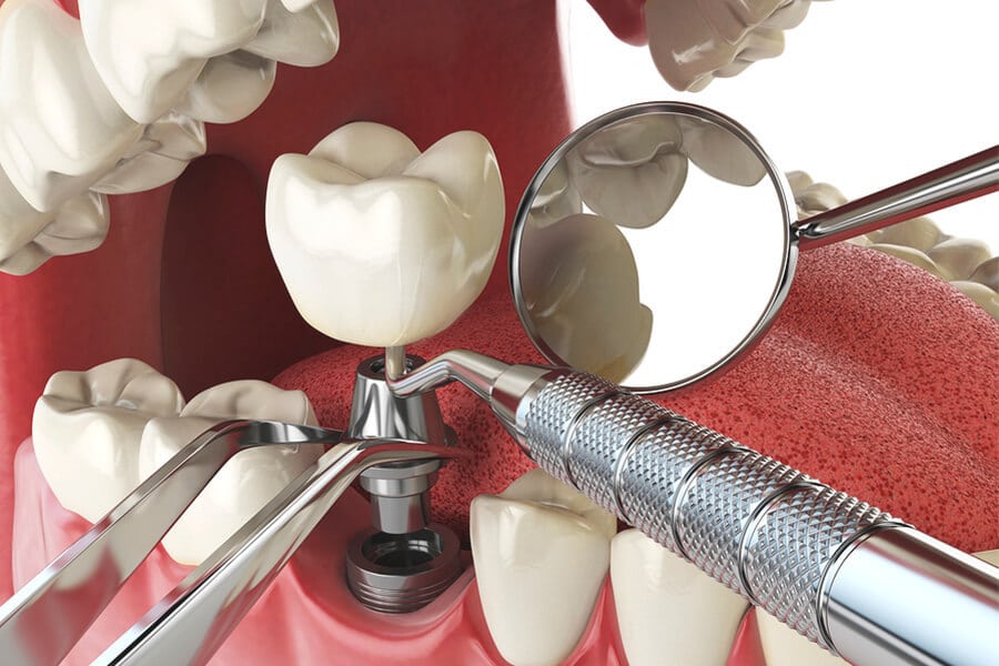 Dental Impants: How to Evaluate the Right Solution - Featured Image