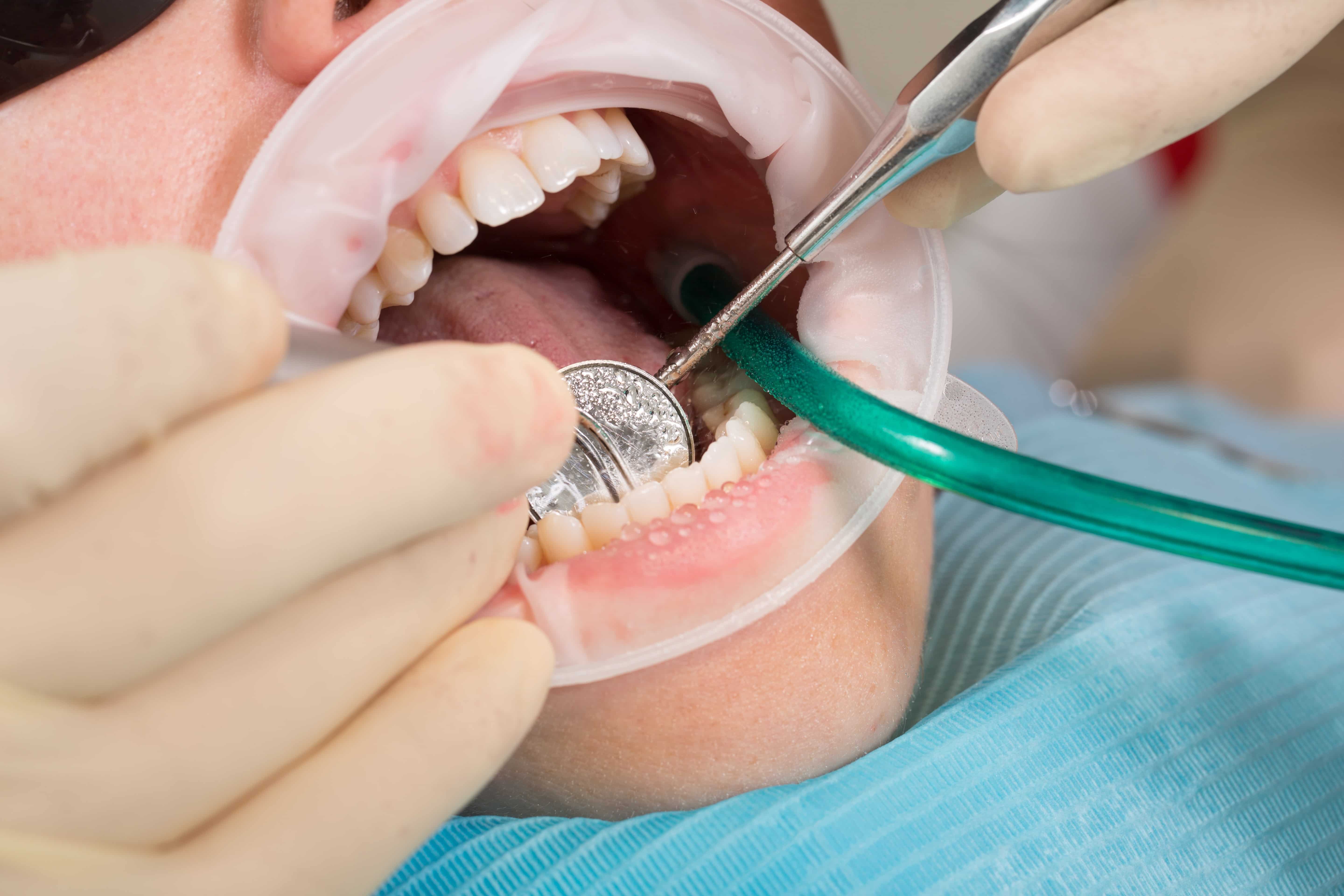 Replacing Dental Crown