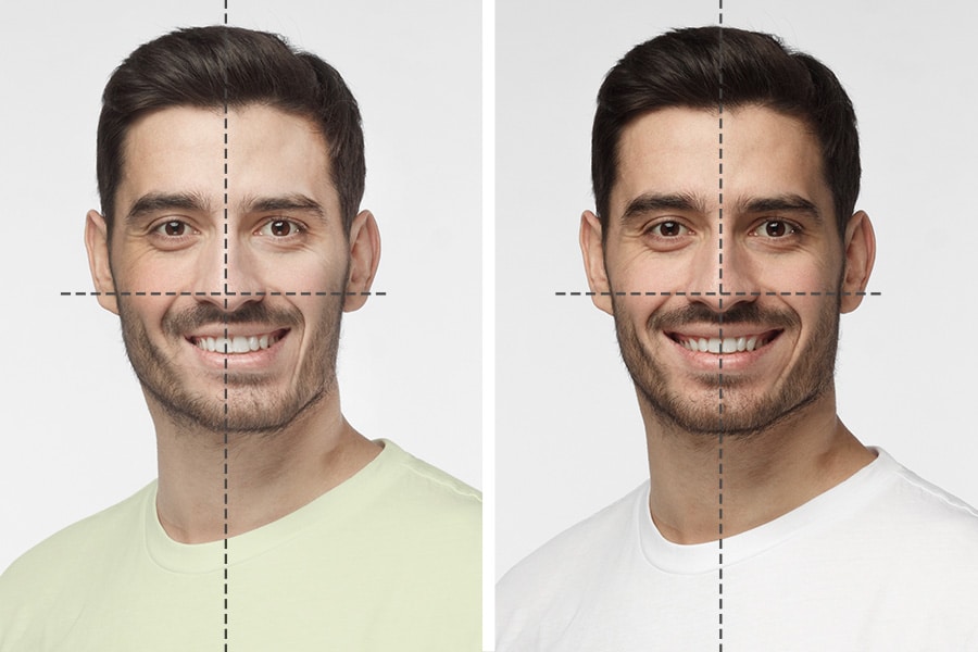 Can we fix asymmetrical face?