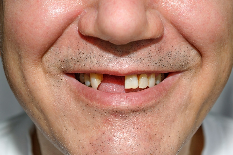 Tooth Loss in Adults