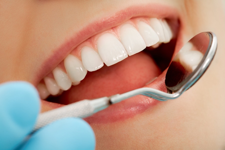 Dental Bonding vs Veneers: A Quick Guide - Featured Image