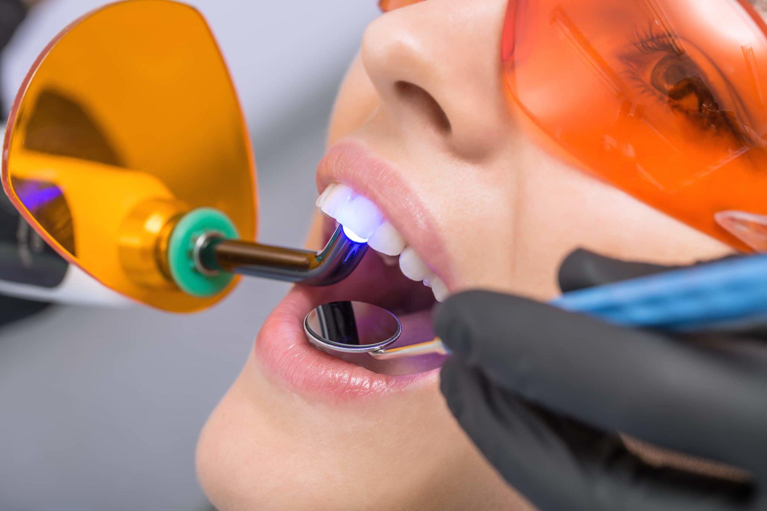 How Much Do Lumineers Cost East Valley Dental Professionals