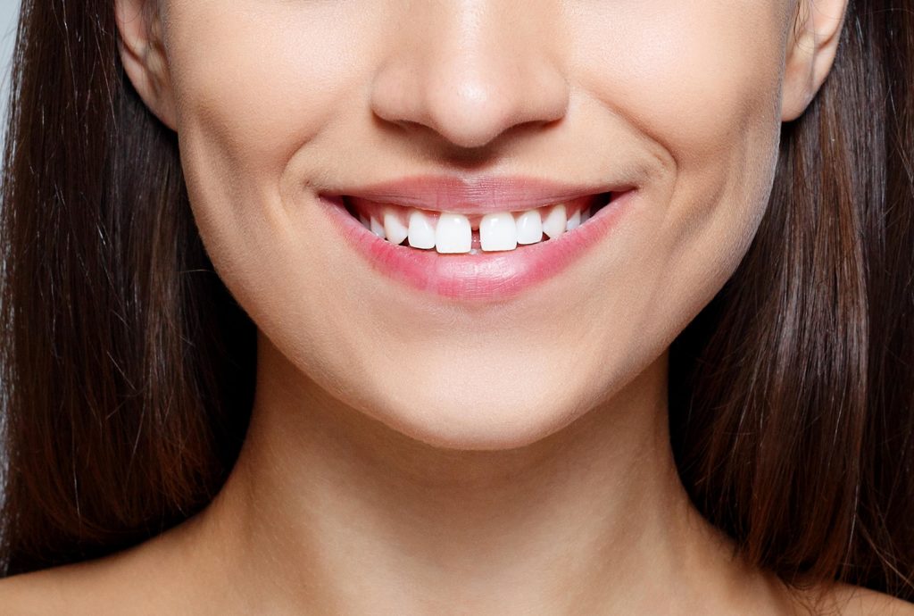 gap between teeth