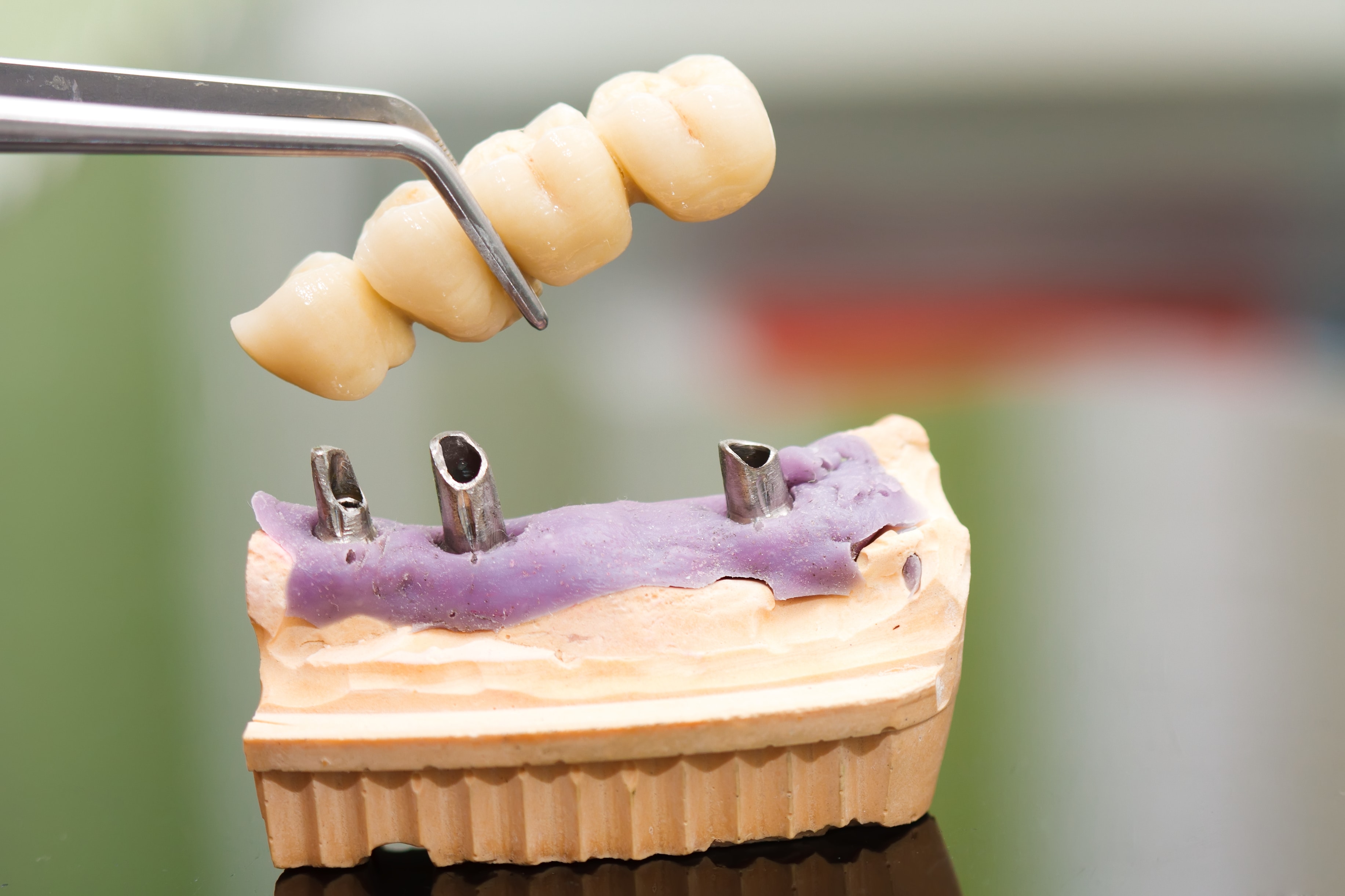 Dental Bridge vs. Dental Implant - Featured Image