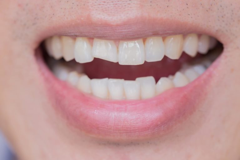 Chipped Tooth Repair Cost East Valley Dental Professionals