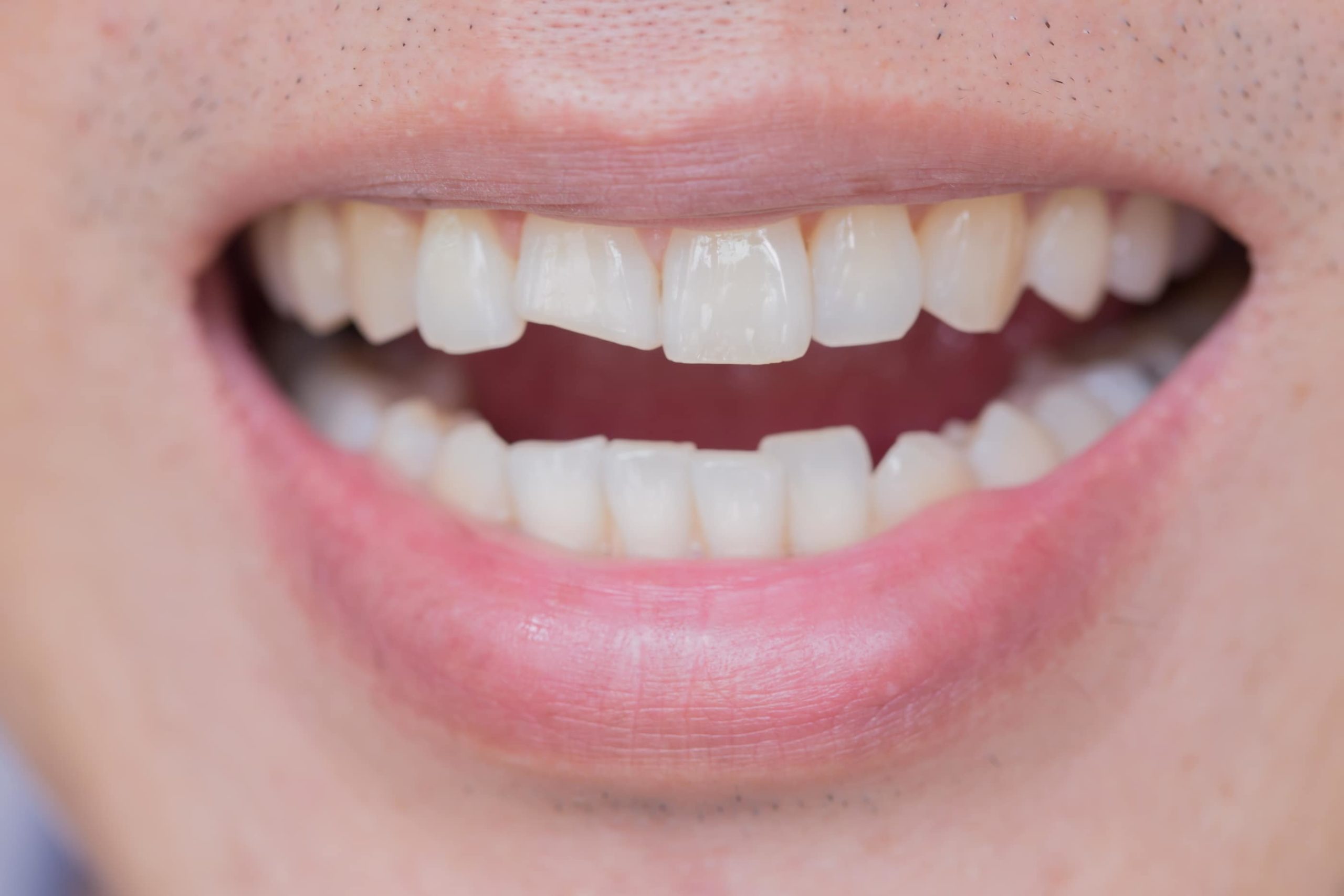 Chipped Tooth Repair Cost | East Valley Dental Professionals