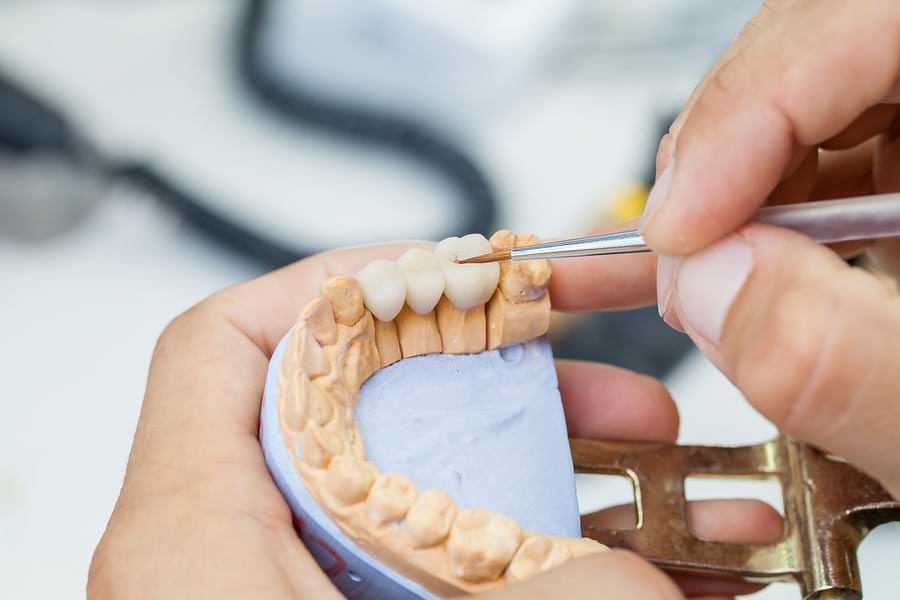 Types of Dental Bridges - Featured Image