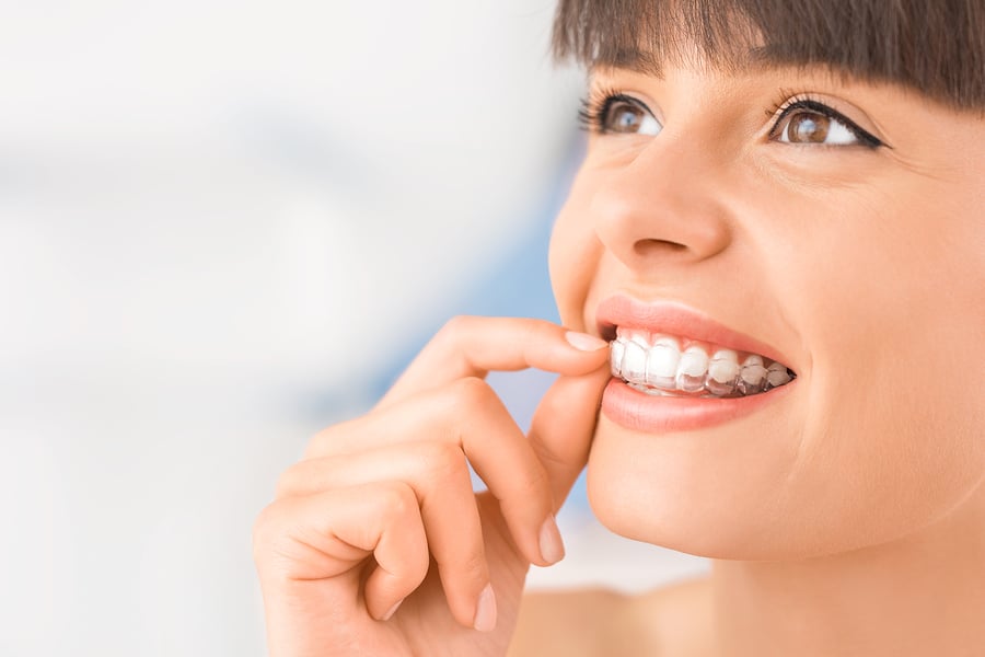 How Much Invisalign Aligners Cost And How To Budget For Them?