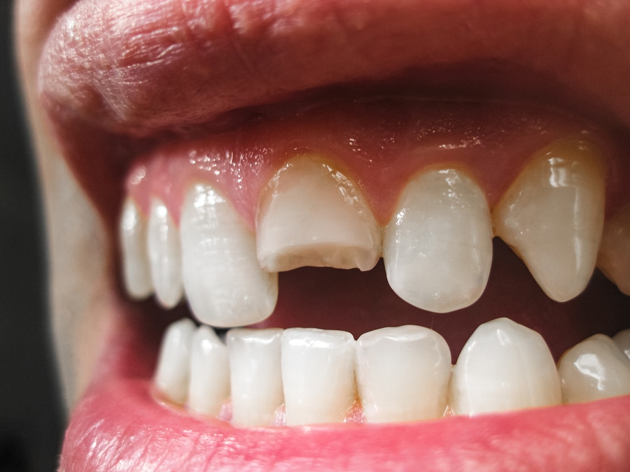 Broken Denture Tooth