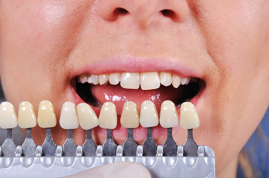 Making Bigger Teeth Smaller - Featured Image