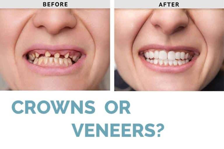 The Difference Between Dental Crowns And Veneers vrogue.co