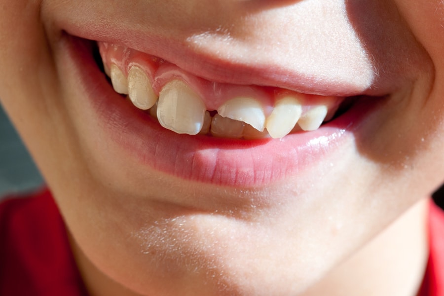 Cost to Fix Broken Tooth East Valley Dental Professionals