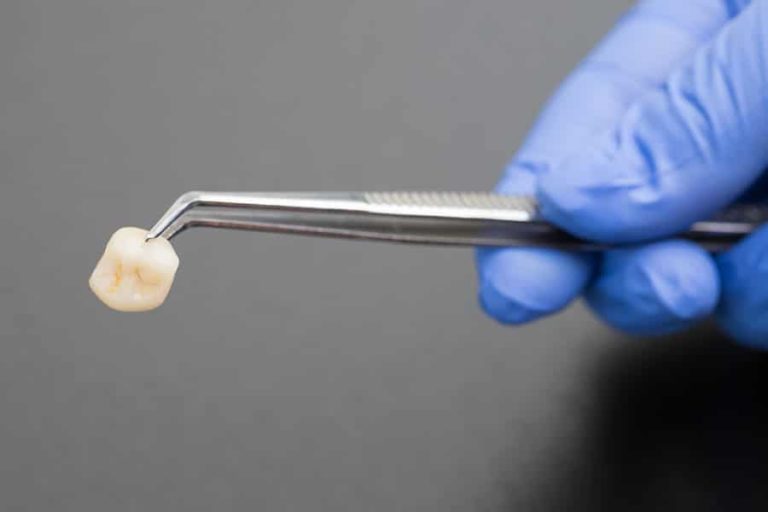 How Much Do Veneers Cost in Arizona EVDP