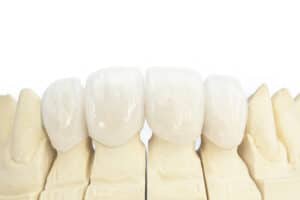 Dental Crowns vs Veneers