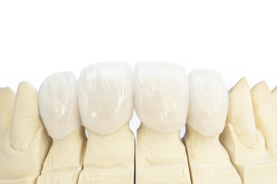 Dental Crowns vs Veneers