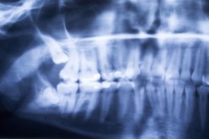 Wisdom Teeth Removal Procedure