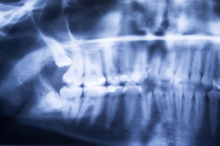 Wisdom Teeth Removal Procedure