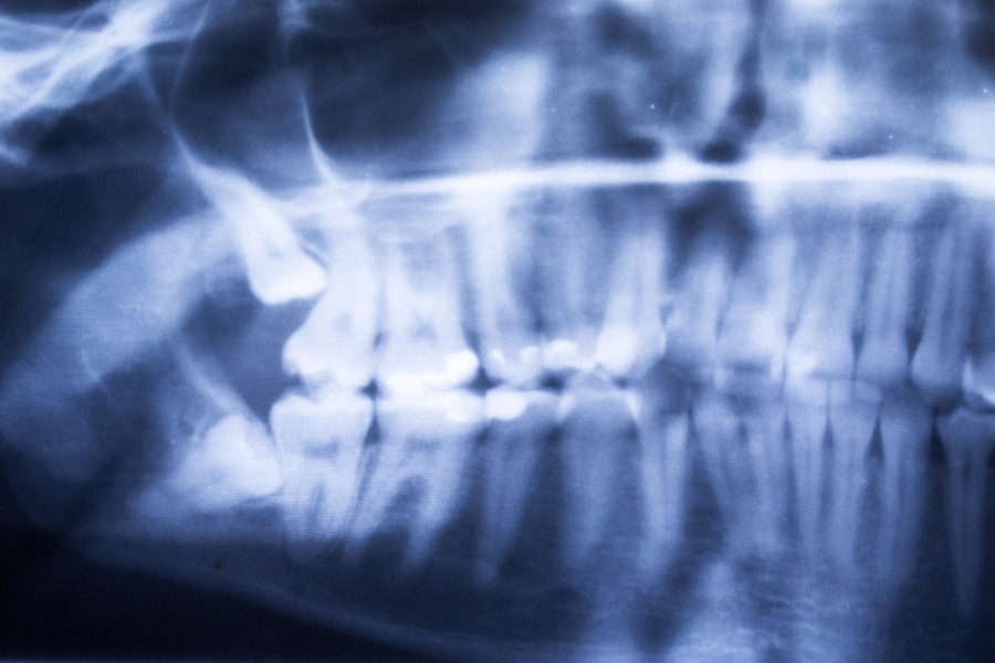 Wisdom Teeth Removal Procedure and Recovery - Featured Image