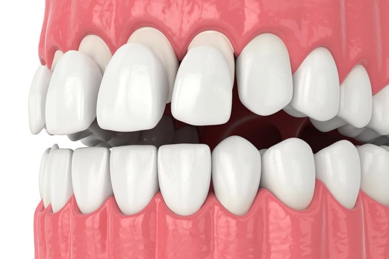 Composite Veneers Are They Worth It? EVDP