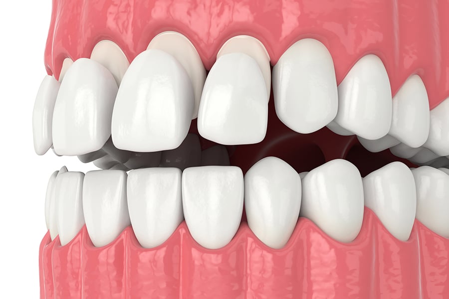 Composite Veneers