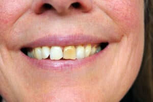 Stained Teeth Causes