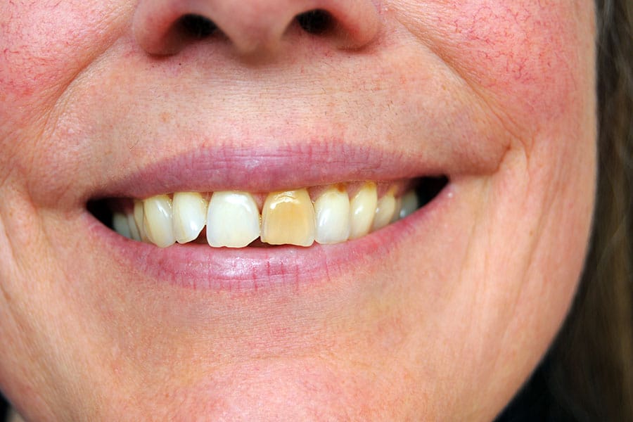 Stained Teeth Causes, Prevention, and Treatment - Featured Image