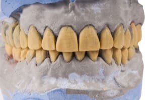 Tooth Erosion Symptoms