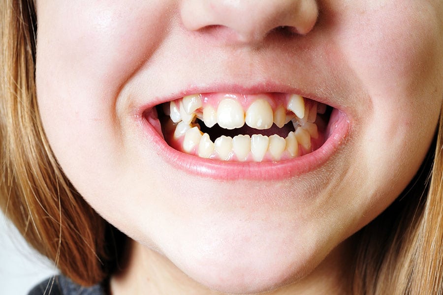 How Invisalign for Crooked Teeth Gives Your Confidence Back - Featured Image