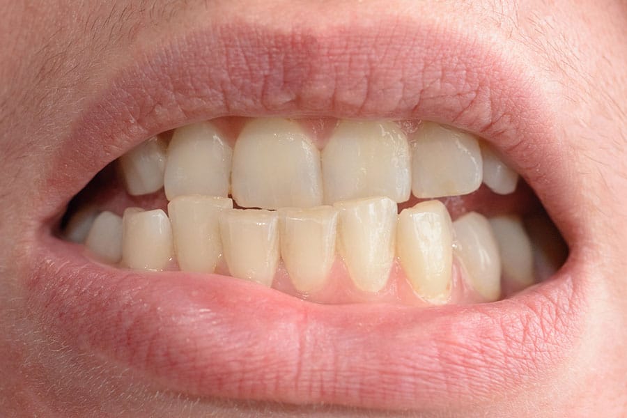 Crooked Teeth Causes and Treatment - Featured Image