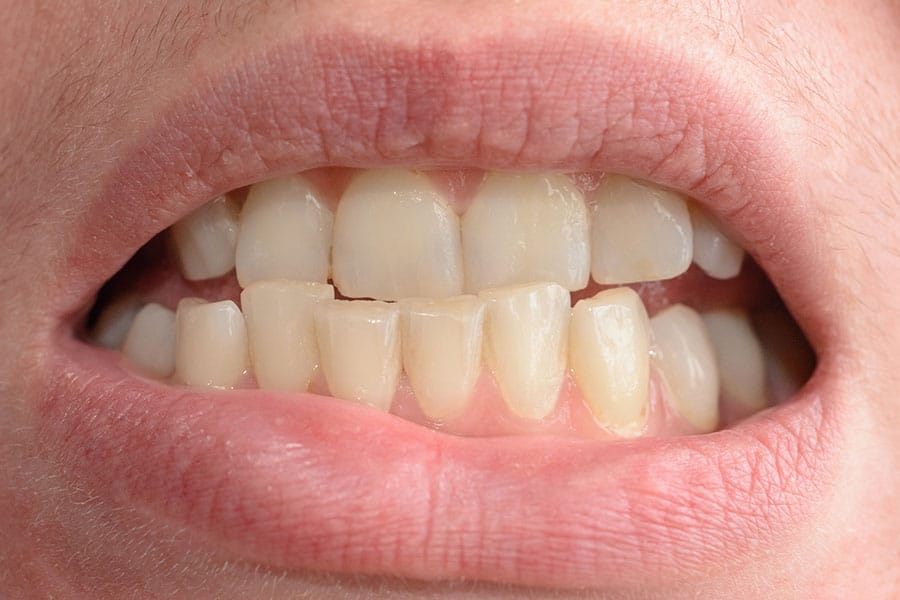 crooked teeth causes