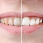 professional teeth whitening vs at home