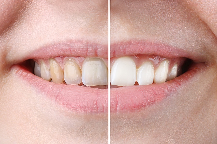 professional teeth whitening vs at home
