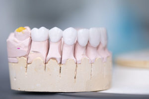 types of dental crowns