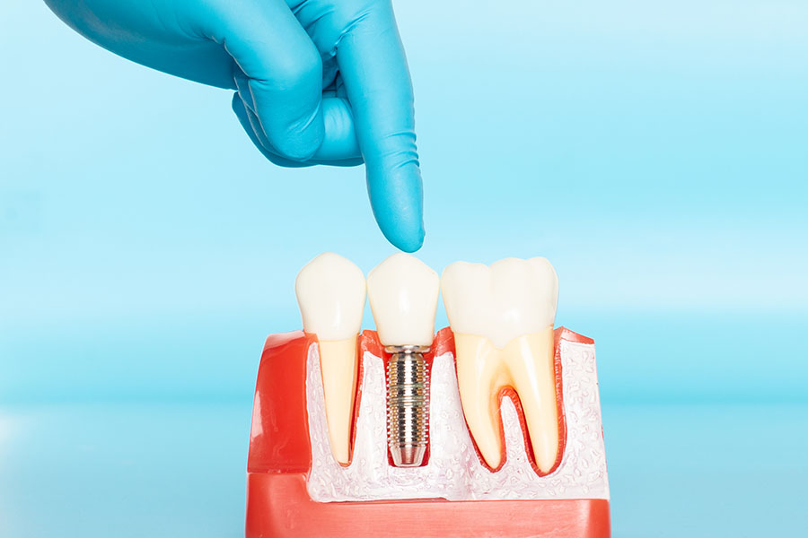 how long do dental implants last