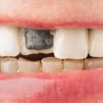 porcelain fused to metal crowns problems