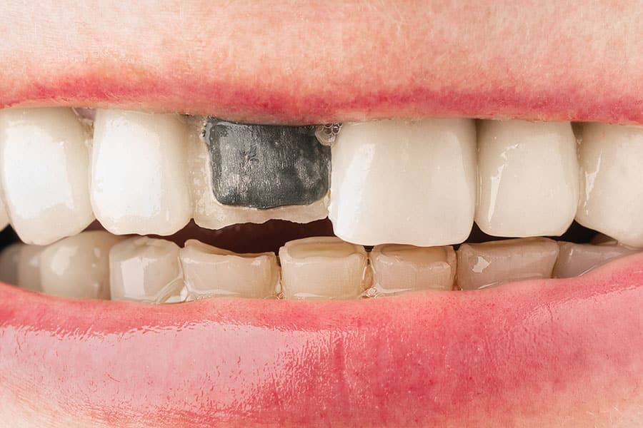 porcelain fused to metal crowns problems