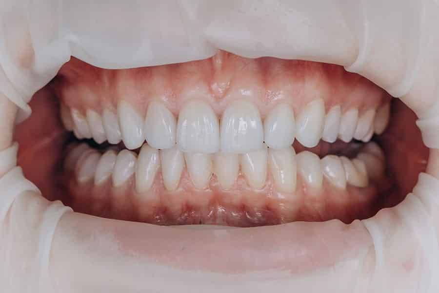 dental crowns on front teeth