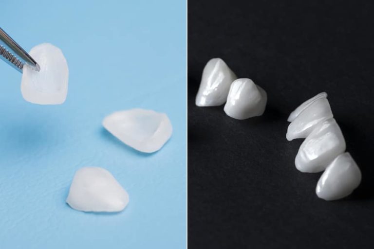 Veneers vs Lumineers East Valley Dental Professionals