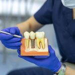 dental implants vs crowns