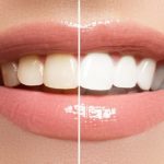 veneers before and after