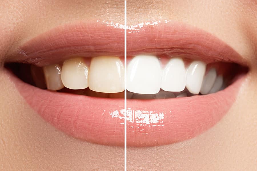 Porcelain Veneers Before and After - Featured Image