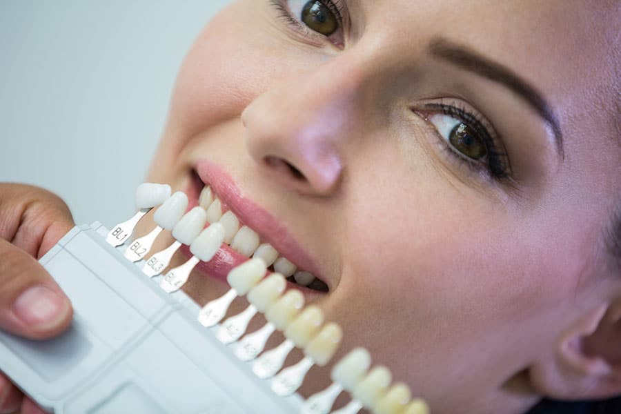 What Are Temporary Veneers? - Featured Image