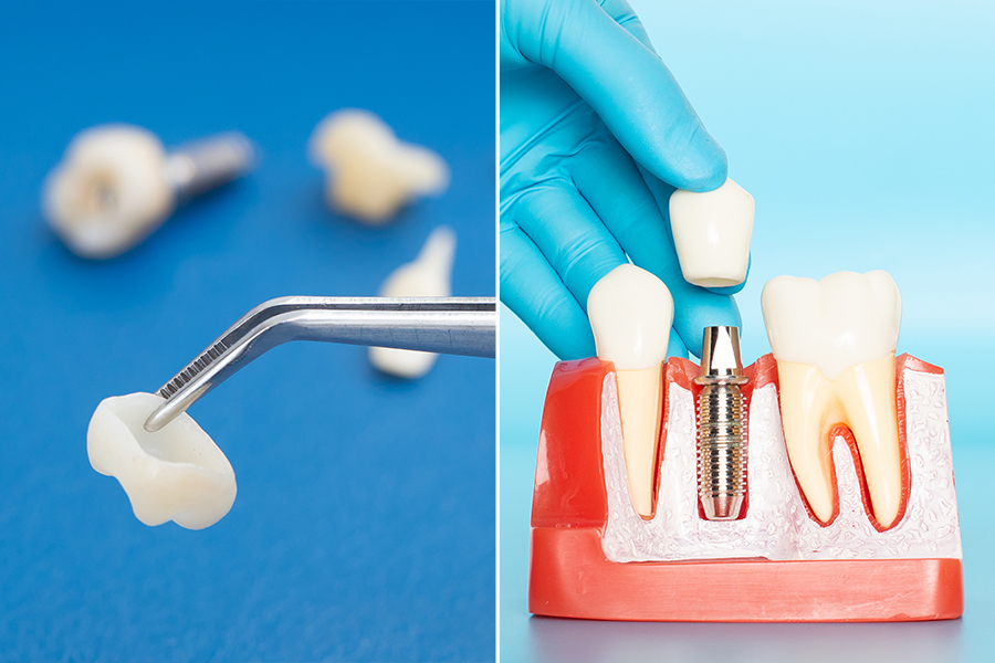 Veneers vs Implants - Featured Image